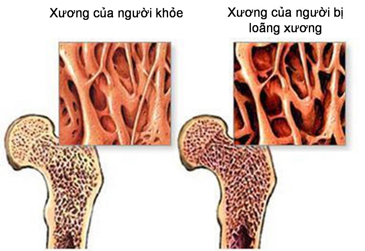 Hạt Chia và nước mật ong có thể giúp cải thiện mật độ xương, giảm nguy cơ loãng xương.