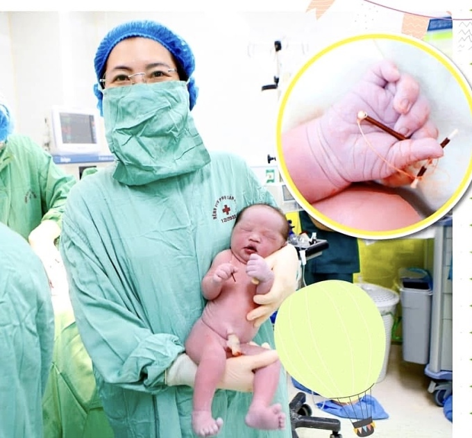 Em bé chào đời cùng vòng tránh thai của mẹ. Ảnh: Bệnh viện cung cấp