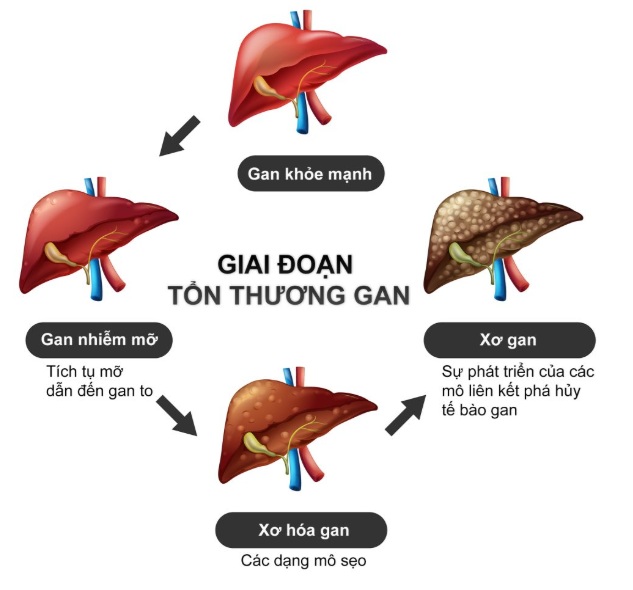 Virus viêm gan B khiến gan khỏe mạnh phát triển thành xơ gan. Ảnh minh họa