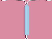 Chuẩn bị mang thai - Muốn mang thai sau khi tháo vòng tránh thai cần lưu ý gì?