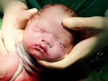 Thai nhi bị dây rốn quấn cổ có đẻ thường được không?