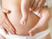 Bà bầu - 5 vấn đề về da phụ nữ thường gặp sau sinh con