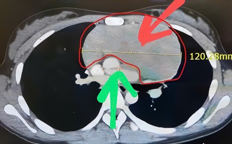 Mũi tên đỏ là khối u khổng lồ trên 12cm, mũi tên xanh là động mạch chủ và các mạch máu lớn khác. 