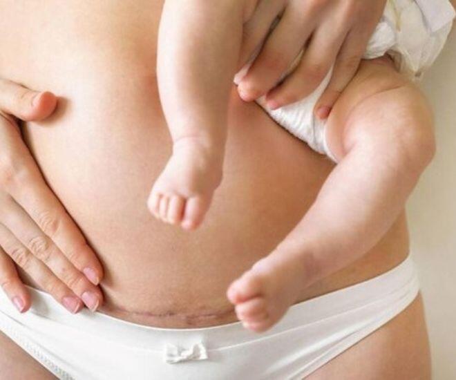 Vết rạn da là một trong những vấn đề thường gặp sau sinh, đặc biệt là đối với những phụ nữ tăng cân nhanh chóng trong thai kỳ.