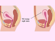 Bà bầu - Nếu có tử cung ngả sau, mẹ bầu nên cân nhắc chuyện sinh mổ, vì sao?