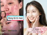 Phương pháp trị mụn bằng tỏi "hot" trên TikTok có thực sự hiệu quả hay hại da? Bác sĩ da liễu chỉ cách làm đúng nhất