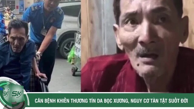 Thương Tín da bọc xương, nguy cơ tàn tật suốt đời vì căn bệnh nguy hiểm này