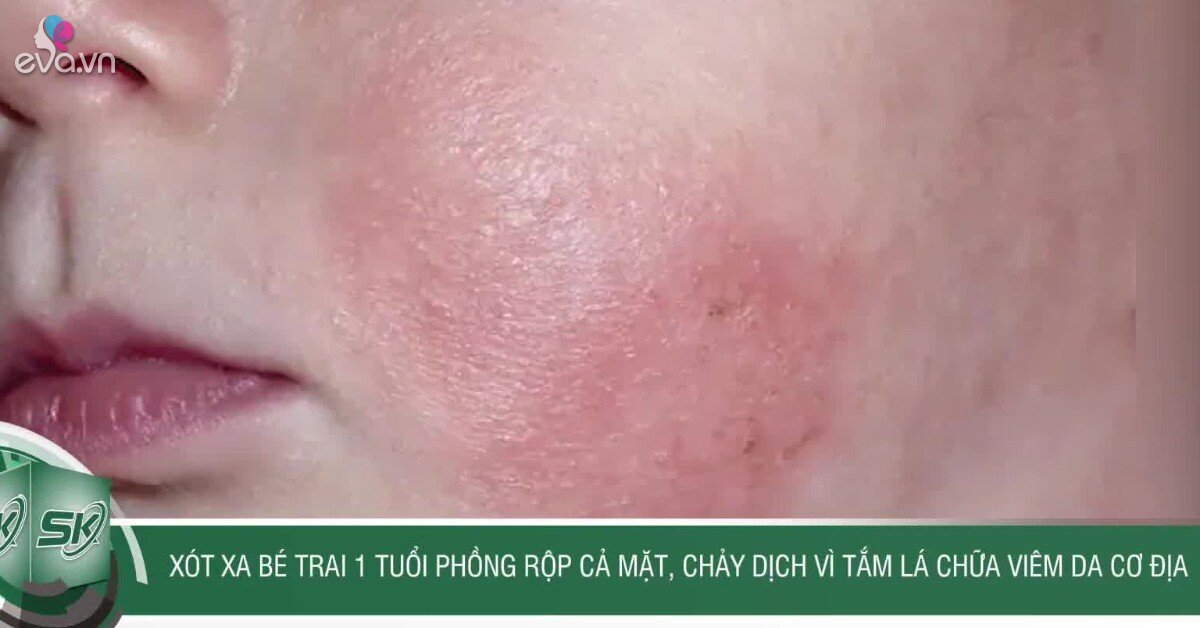 Xót xa bé trai 1 tuổi phồng rộp cả mặt, chảy dịch vì tắm lá chữa viêm ...