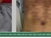 Clip Eva - Da lở loét, bong tróc mảng lớn sau 2 ngày uống thuốc nhiệt miệng