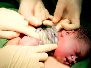 Sức khỏe - Tin vui: Bé gái chào đời khỏe mạnh dù có tới 9 vòng dây rốn quấn cổ rất hiếm gặp