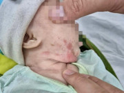 Sức khỏe - Đưa con 2 tháng tuổi đi điều trị giang mai, tới viện bố mẹ mới biết bản thân mình cũng mắc bệnh