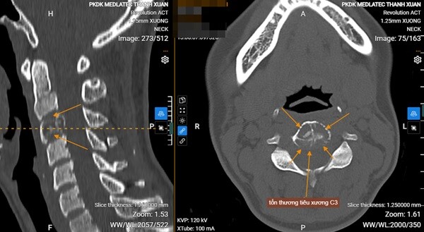 Nữ nhân viên văn phòng đau cổ vai gáy tưởng do ngồi nhiều, đi khám mới biết xương đã bị tiêu vì quá chủ quan - 2