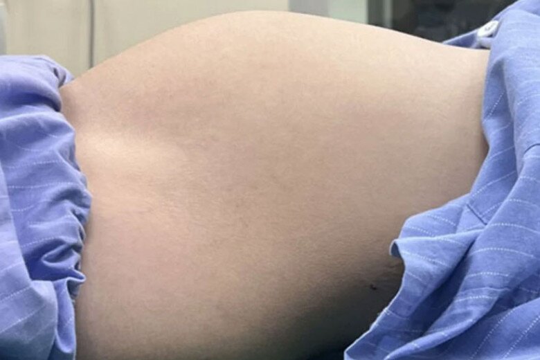 Bụng của thiếu nữ to như đang mang thai 6 tháng vì có khối u nang buồng trứng khủng. Ảnh: BVCC.