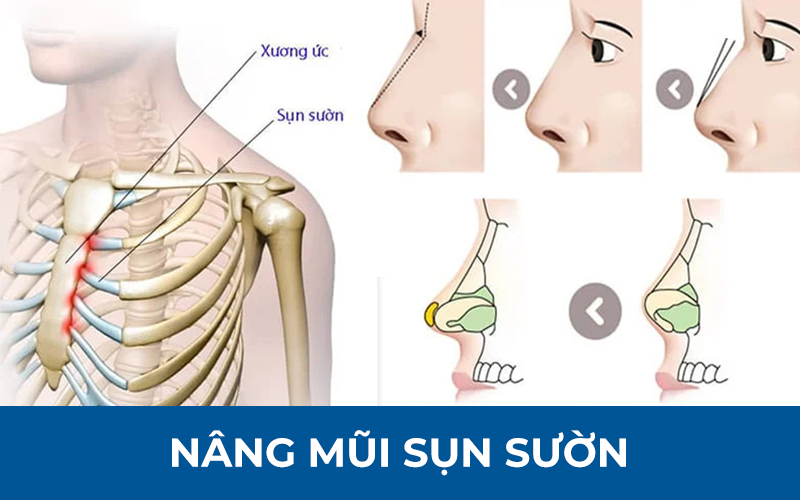 Sơ đồ mô phỏng phương pháp nâng mũi bằng sụn sườn