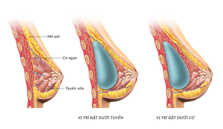 Vị trí đặt túi ngực dưới tuyến sữa amp; dưới cơ ngực