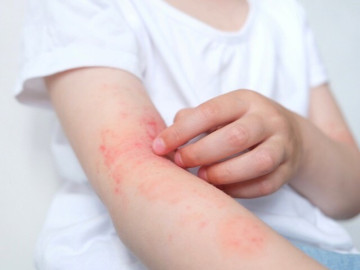 Cả nhà cùng mắc căn bệnh khiến cơ thể nổi mụn, ngứa ngáy, nguyên nhân phía sau mới thật sự bất ngờ