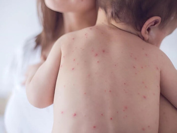 Bé trai 1 tuổi phồng rộp hết cả mặt, bác sĩ chỉ thủ phạm từ hành động thường ngày, nhất là khi trời lạnh