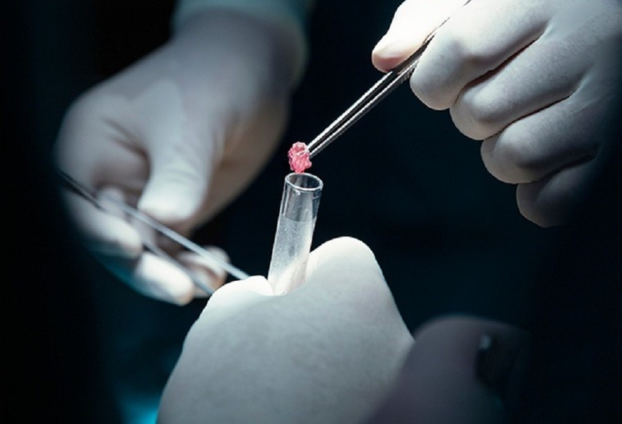 Các bác sĩ đã lấy mẫu bệnh phẩm thực hiện sinh thiết cho người bệnh (ảnh minh họa)