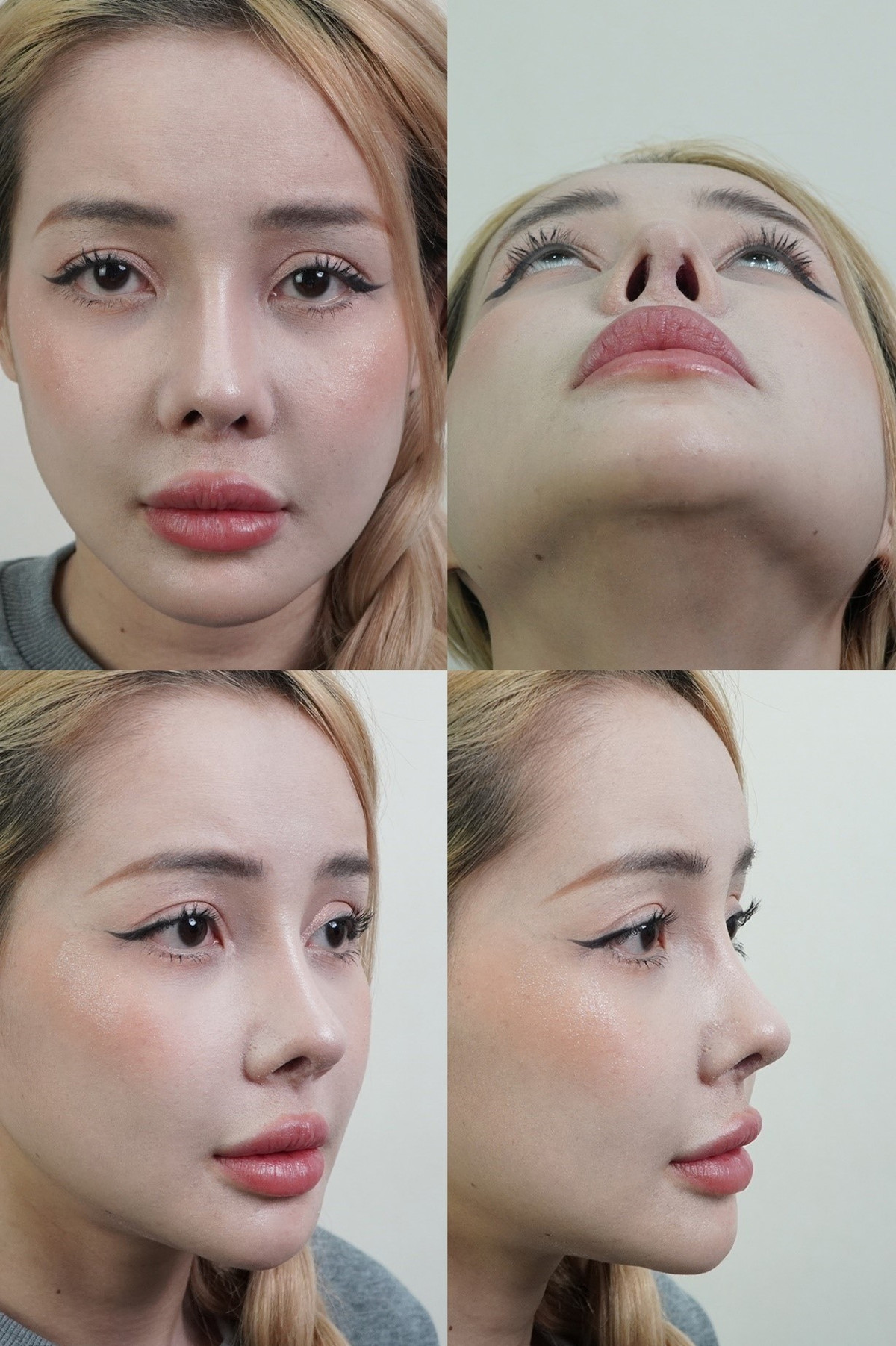 10 năm qua, Ngân 98 từng amp;#34;nghiệnamp;#34; phẫu thuật thẩm mỹ ra sao? - 10
