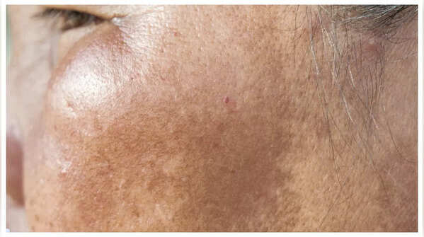 Tốc độ tái tạo tế bào da cũng chậm lại làm da xỉn màu và kém mịn.