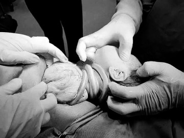 Bé gái chào đời với 6 vòng dây rốn quấn cổ