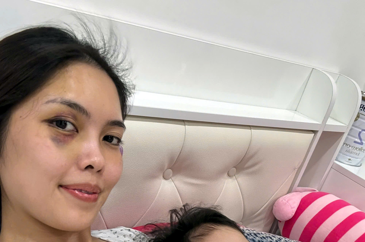 Sau khi ra viện, mặt chị Trang vẫn còn thâm tím. Ảnh: Nạn nhân cung cấp