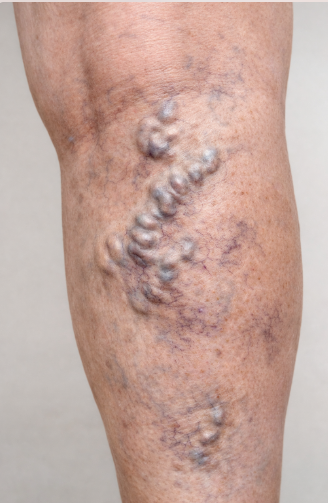 Suy giãn tĩnh mạch không chỉ là vấn đề thẩm mỹ mà còn ảnh hưởng đến chất lượng sống.