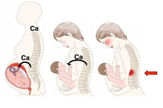 Nếu chế độ dinh dưỡng của mẹ không đáp ứng đủ canxi sẽ gây tình trạng loãng xương sau sinh.