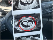 Bà bầu - Đi siêu âm thai ở tuần thứ 20, mẹ trẻ “sốc toàn tập” khi bác sĩ đưa ra kết luận không ngờ