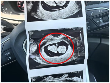 Đi siêu âm thai ở tuần thứ 20, mẹ trẻ “sốc toàn tập” khi bác sĩ đưa ra kết luận không ngờ
