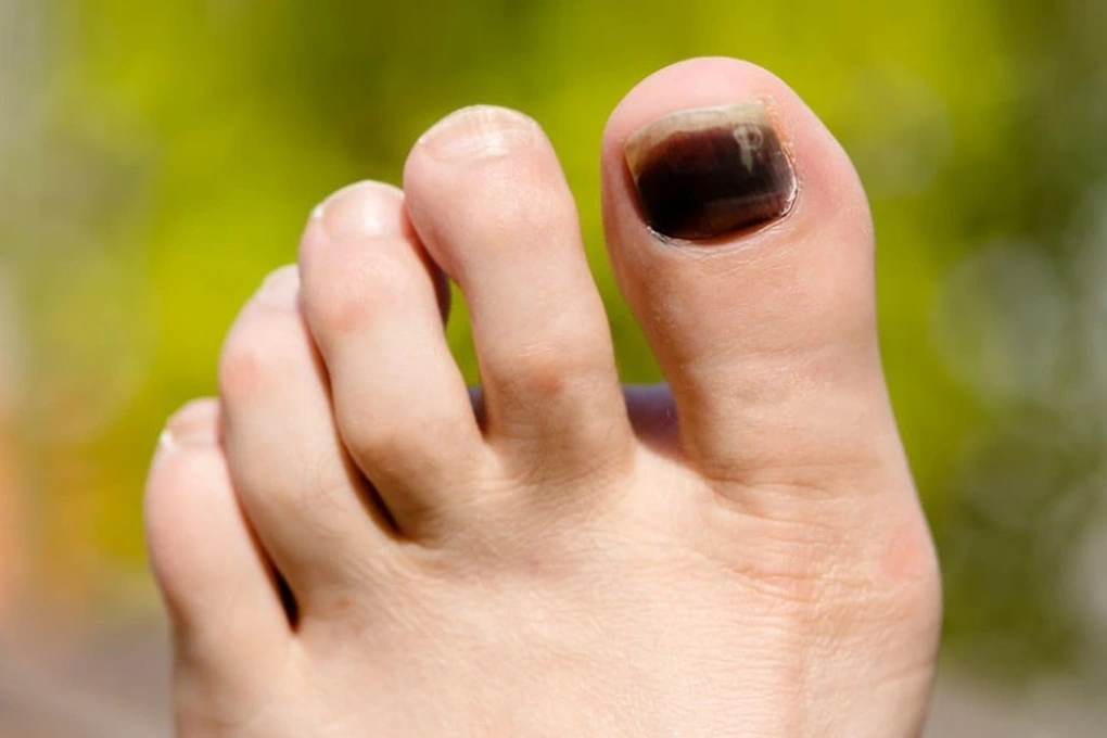 Móng chân màu đen có thể là dấu hiệu của nhiều bệnh lý, trong đó có bệnh liên quan đến gan, thận (Ảnh minh hoạ)