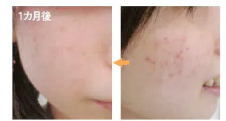 Một thí nghiệm tại Nhật Bản đã chỉ ra sự thay đổi rõ rệt của làn da sau một thời gian áp dụng phương pháp rửa mặt bằng đường.