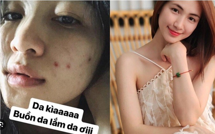 Nữ ca sĩ Hòa Minzy từng uống rau diếp cá để trị mụn nội tiết.