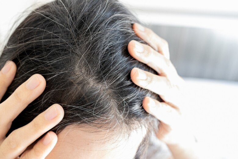 Nhiều người trẻ đã bị tóc bạc vì nhiều nguyên nhân khác nhau.