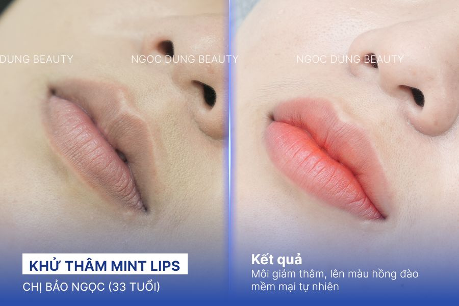 Kết quả khử thâm môi của chị Bảo Ngọc