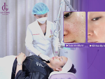 Giải mã sức hút Deep FX Laser: Công nghệ thu nhỏ lỗ chân lông thế hệ mới đang “gây bão” tại LG Clinic