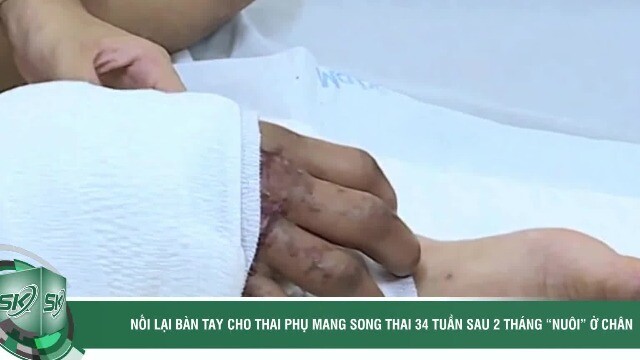 Nối lại bàn tay cho thai phụ mang song thai 34 tuần sau 2 tháng 'nuôi' ở chân