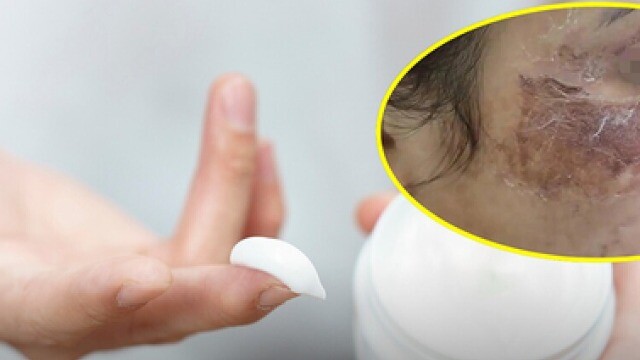 Mua hũ kem ‘xịn’ theo lời bạn bè, cô gái phải vào viện vì da sưng đỏ, phù nề nặng