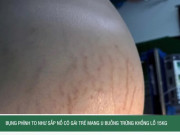 Clip Eva - Bụng phình to như sắp nổ cô gái trẻ mang u buồng trứng khổng lồ 15kg