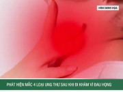 Clip Eva - Phát hiện mắc 4 loại ung thư sau khi đi khám vì đau họng