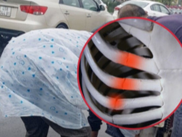 Gặp nạn vì cách dùng áo mưa quen thuộc, bệnh nhân nhập viện gãy nhiều xương sườn