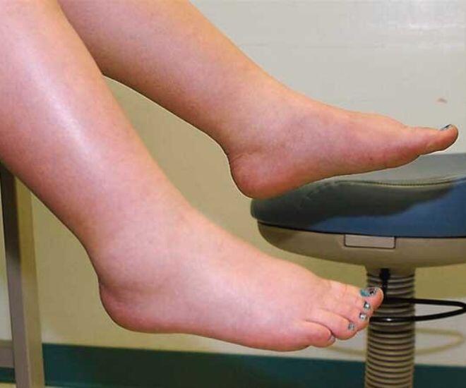 Tình trạng phù chân là dấu hiệu cho thấy gan đã kiệt quệ và khả năng điều hòa dịch của cơ thể bị rối loạn nặng (Ảnh minh hoạ)