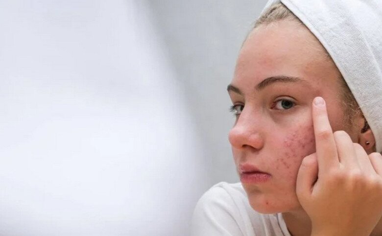 Những người thường xuyên ăn đồ chiên rán, dầu mỡ dễ xuất hiện mụn ở thái dương (Ảnh minh hoạ)