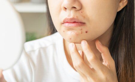 Nguyên nhân xuất hiện mụn ở cằm thường liên quan đến rối loạn nội tiết tố, gây mất cân bằng hormone (Ảnh minh hoạ)