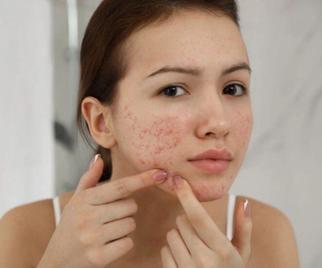 Mụn trên má xuất hiện dày đặc và kéo dài, chứng tỏ gan và phổi đang suy yếu (Ảnh minh hoạ)