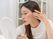 Sức khỏe - 6 vị trí mọc mụn trên mặt cảnh báo sức khoẻ cơ thể đang “kêu cứu”