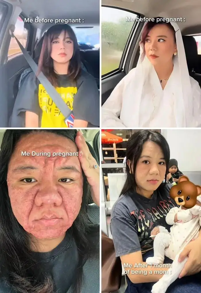 4. Chín tháng bão táp đổi lấy một phép màu: Từ phù nề, mệt mỏi, rụng tóc đến ngày ôm con vào lòng, gương mặt cô lộ rõ sự kiệt sức nhưng xen lẫn niềm tự hào không thể che giấu.