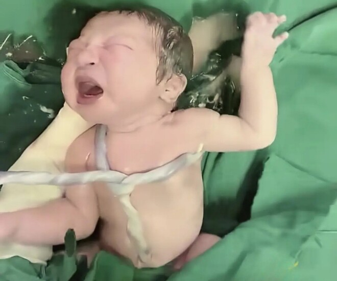 Em bé chào đời với dây rốn thắt nút, thiếu oxy khiến bác sĩ đứng tim.