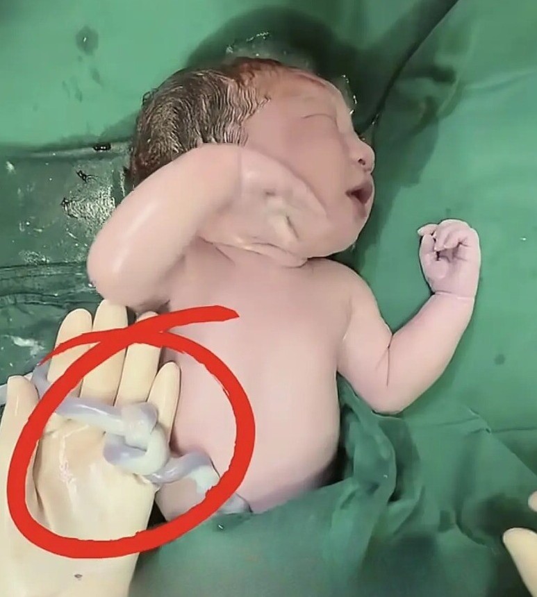 Em bé chào đời bên vật thể lạ khiến cả ê-kíp đứng tim, hành động tuyệt vời của mẹ khi mang bầu đã cứu lấy con - 2