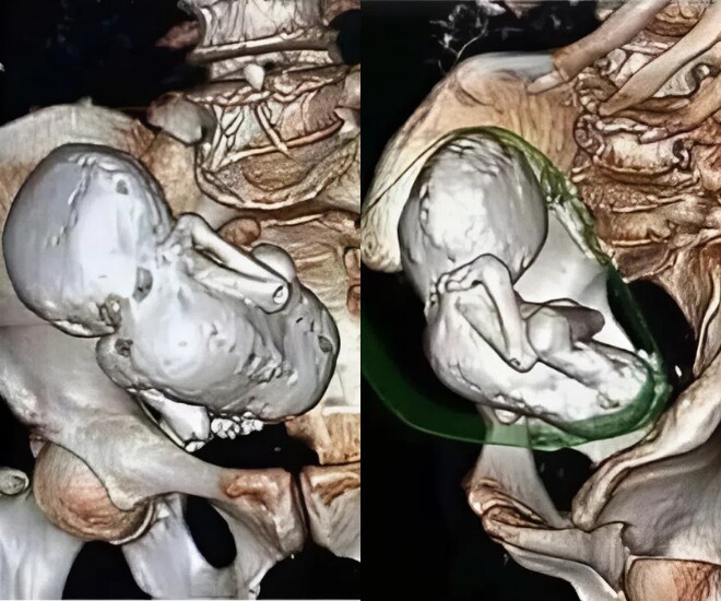 Phim chụp CT cho thấy thai nhi hoá đá trong bụng cụ bà 73 tuổi.